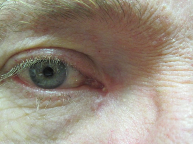 Eyelid lumps and lesions | The BMJ